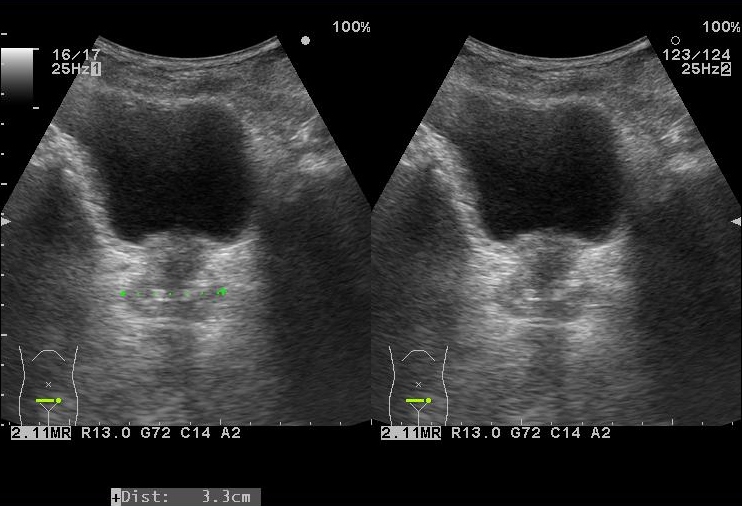 前立腺肥大症の人は全員投薬が必要ですか?